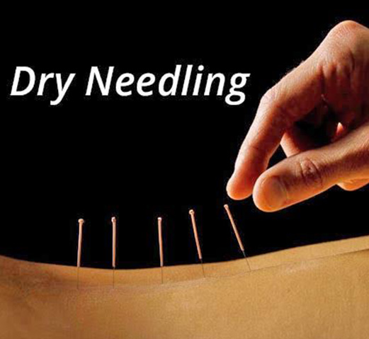 Dry needling in Bendigo